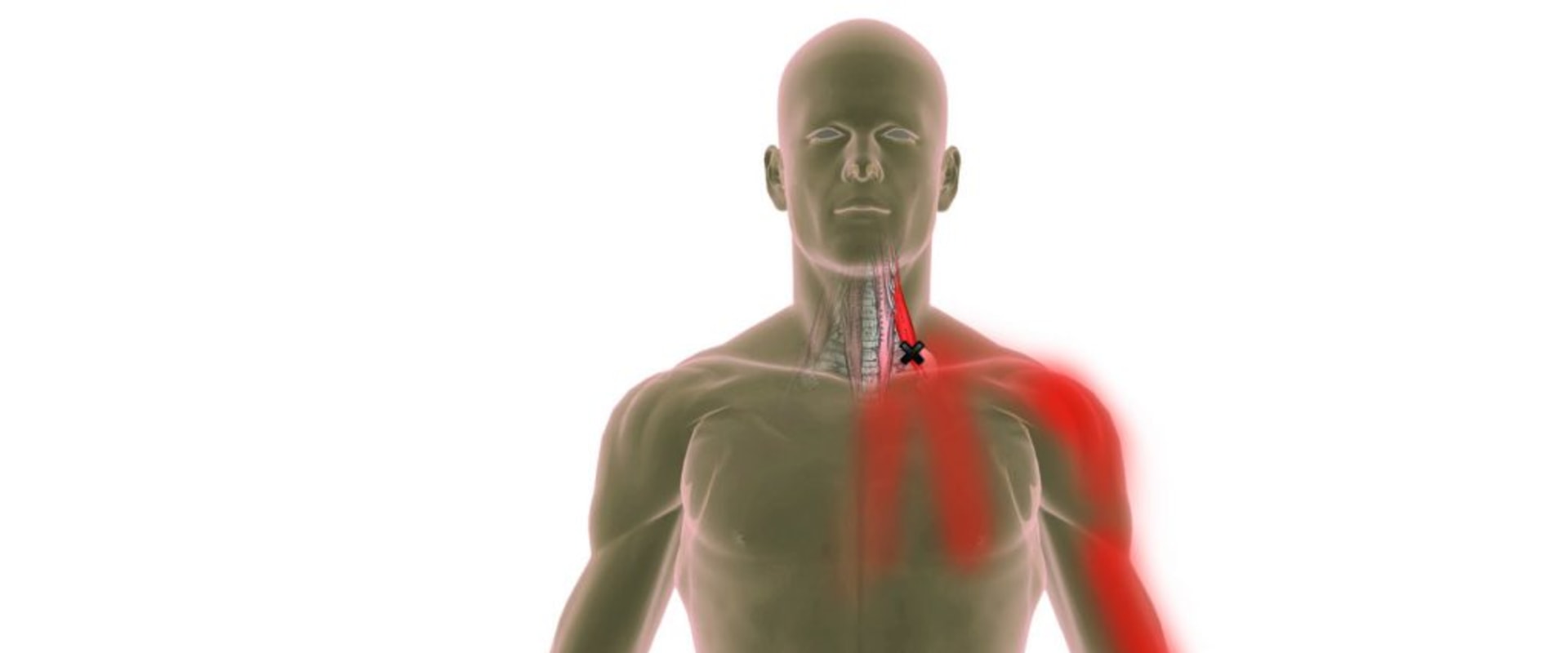 Can Trigger Points Cause Nerve Damage?