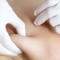 Are Trigger Point Injections Safe and Effective for Pain Relief?