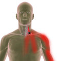 Can Trigger Points Compress Nerves? An Expert's Perspective