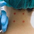 Can Trigger Point Injections Cause Reactions?