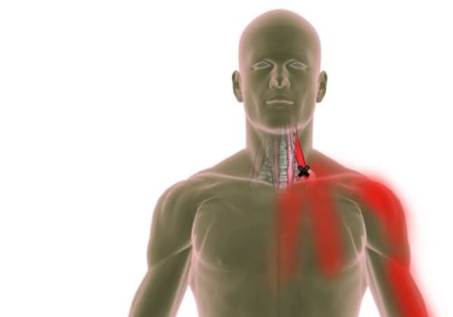 Can Trigger Points Cause Nerve Damage?