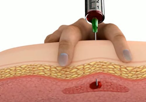 What are Trigger Point Injections Used For?