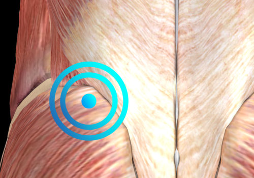 How Long Does it Take to Release Trigger Points?