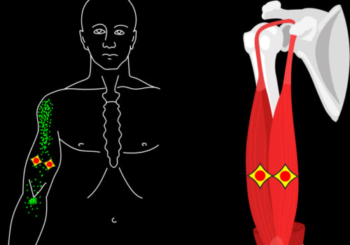 How Long Does Trigger Point Injection Therapy Last?